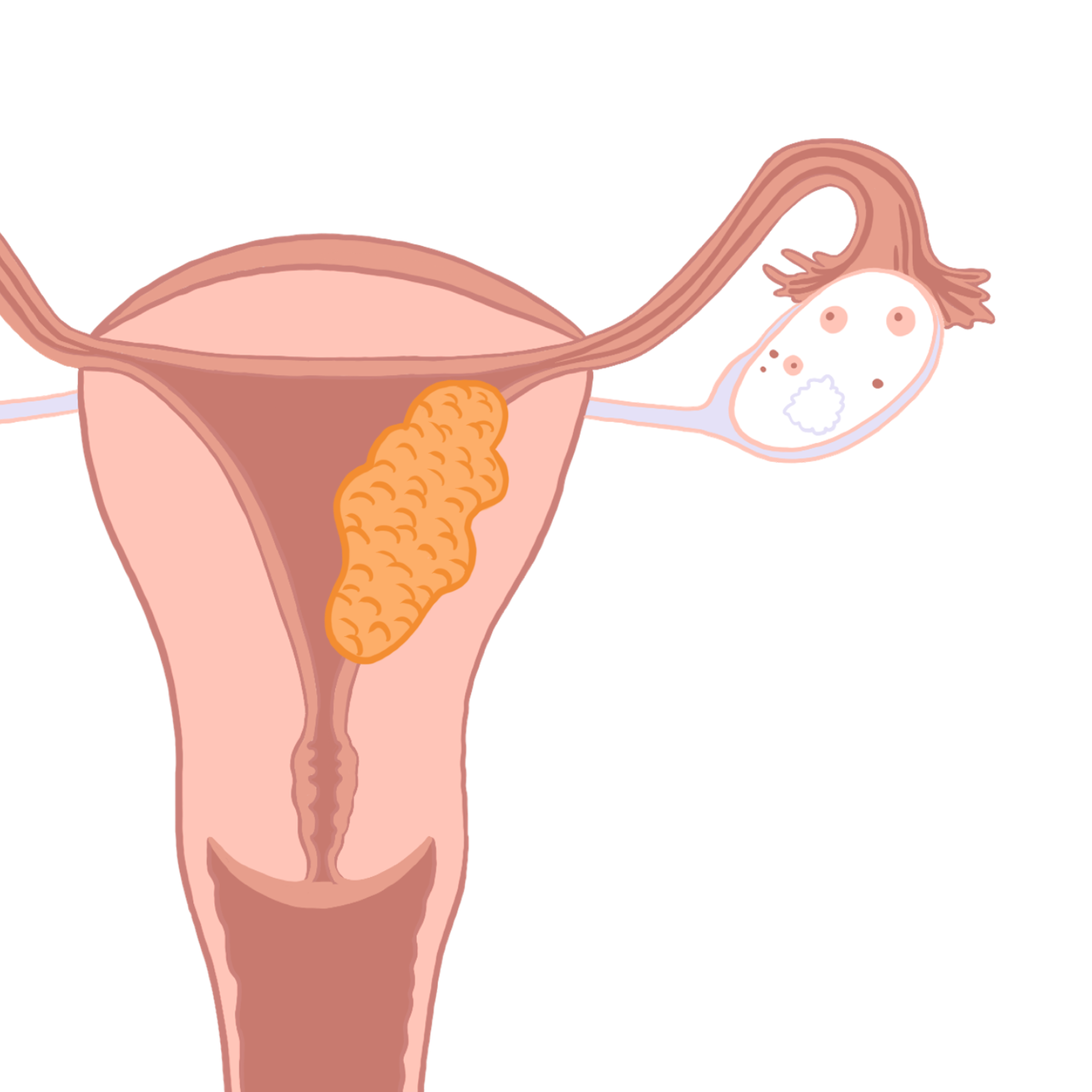 Что такое рак эндометрия (матки)